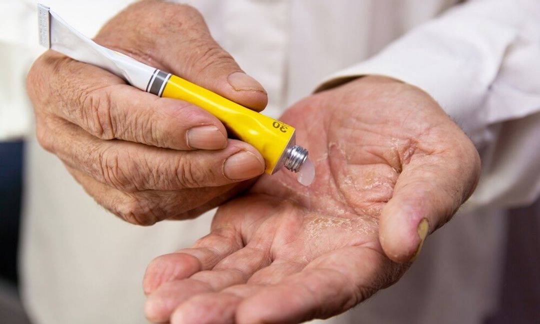 13 Alternatives To NSAIDS For Pain And Inflammation GlycanAge